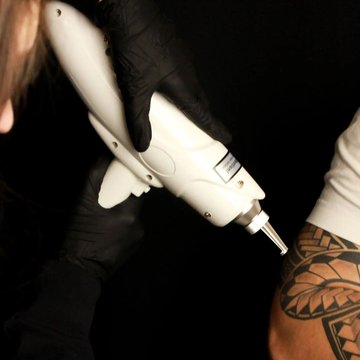 Laser tattoo removal in Liepaja