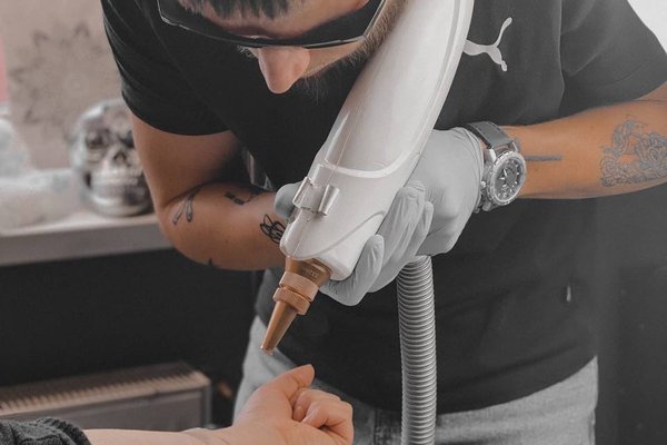 Laser tattoo removal in Liepaja