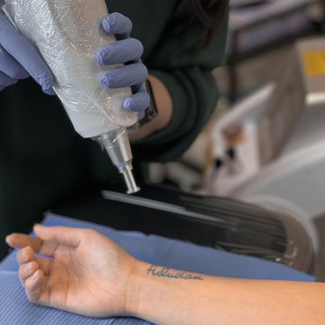 Tetovējuma noņemšana ar lāzeru Jūrmalā
