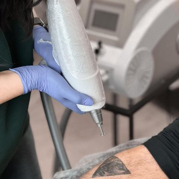 Tetovējuma noņemšana ar lāzeru Jūrmalā