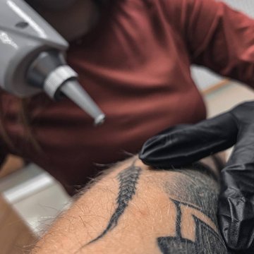 Tattoo Removal in Daugavpils