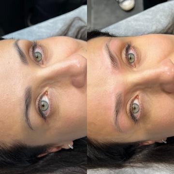 Laser lightening of eyebrow permanent makeup