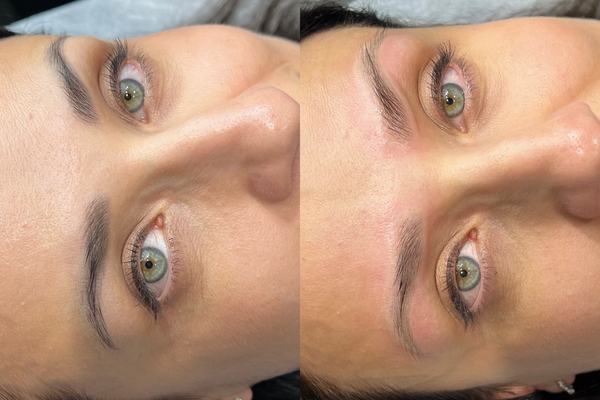 Praktiska nodarbība tetovējumu izgaismošanā ar lāzeru