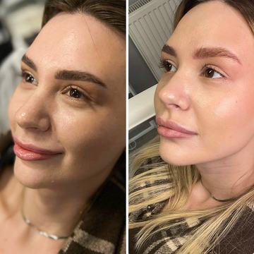 Laser lightening of eyebrow permanent makeup