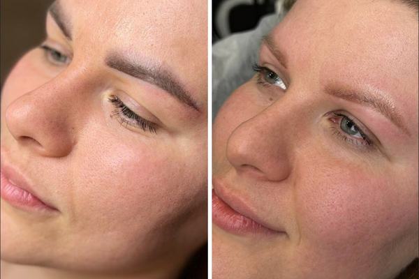 laser lightening of eyebrow permanent makeup