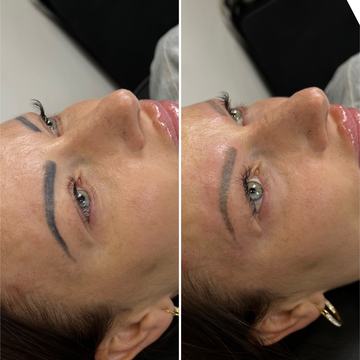 Laser lightening of eyebrow permanent makeup