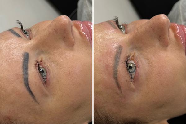 Praktiska nodarbība tetovējumu izgaismošanā ar lāzeru